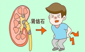 肾里竟能种石头你的肾还好吗