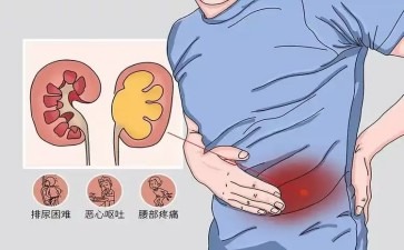 肾脏也会涨洪水肾结水究竟咋回事