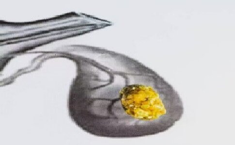 胆囊里安家的石头是结石在定居