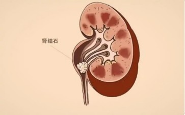 肾里咋能长出钻石般硬物