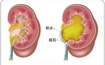 肾里咋就积了水闹脾气