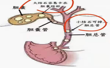 胆总管里藏石怪身体为何会闹灾