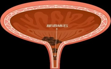 结石医院长春尿道结石藏在排尿路上的小石头会闹啥大动静
