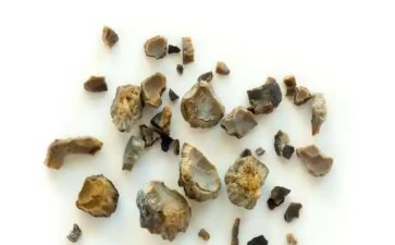 前列腺里安家的石头是身体在预警