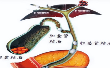 胆总管里安家的石头是身体在呼救