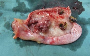 长春碎石医院胆囊息肉藏在胆囊里的不定时炸弹