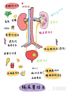 输尿管为啥总爱堵车这些习惯竟是幕后推手