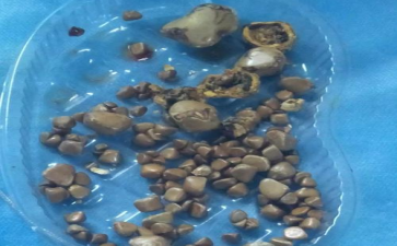 你的胆总管里藏着黄金沙漏吗