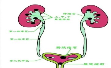 尿道 人体下水管 咋塞了 巨型水垢
