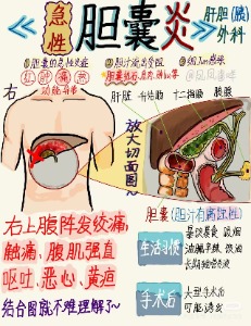 胆囊炎身体里的小火山为何突然爆发