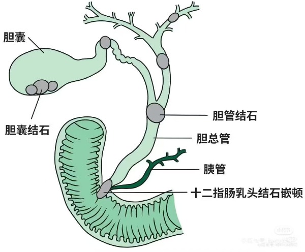 胆总管结石身体里的交通大堵塞从何而起