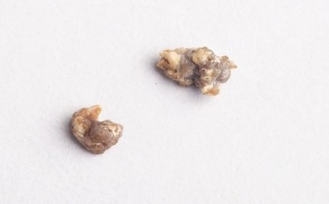 尿道结石是尿路里的调皮小石子吗