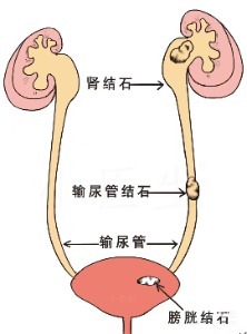 尿道里的不速之客结石为何总爱堵路