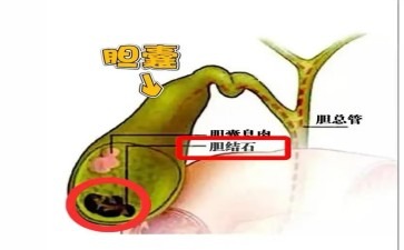 胆囊息肉职场人的隐形压力包袱