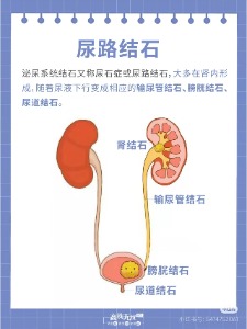 尿道结石排尿路上的疯狂路障从何而来
