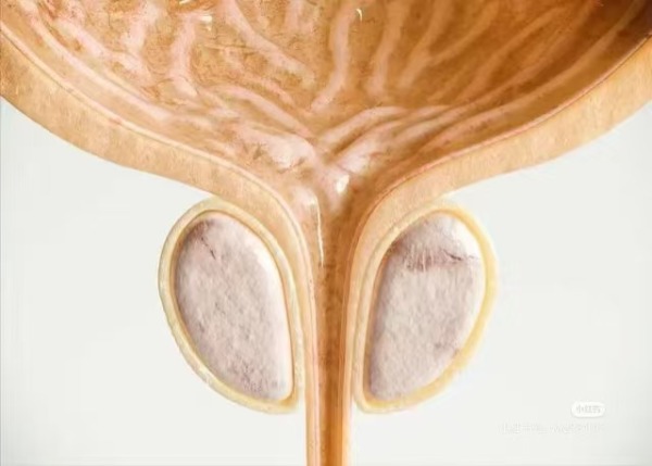 前列腺结石藏在生命腺里的小石子会搞大破坏