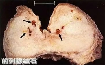 前列腺结石是男性生命腺的小石子在捣乱吗