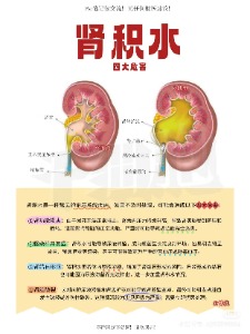 肾积水身体里的隐形水池会淹没健康吗